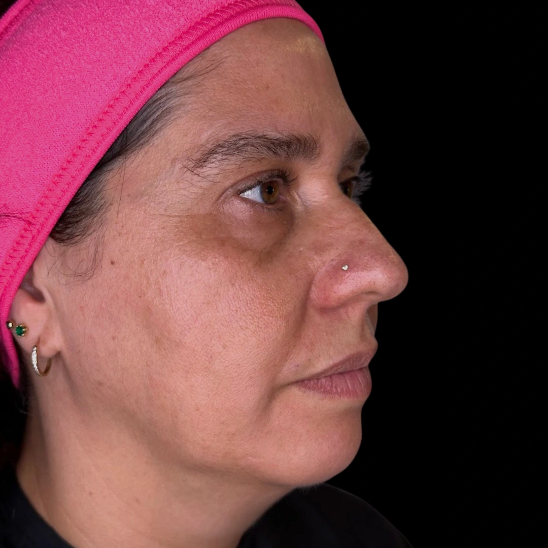 Después Perfil 2